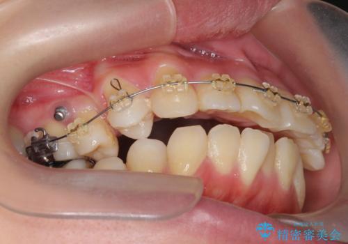 捻れた奥歯 突き出た前歯を治したいの治療中