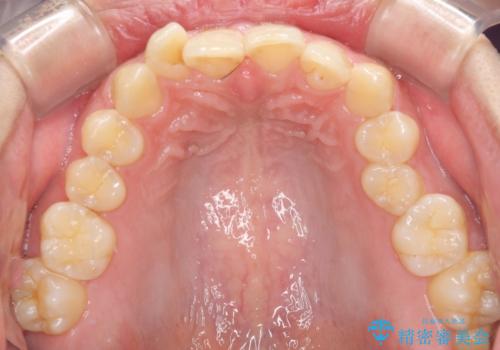 ねじれの強い前歯と奥歯　インビザラインでの矯正治療の治療前