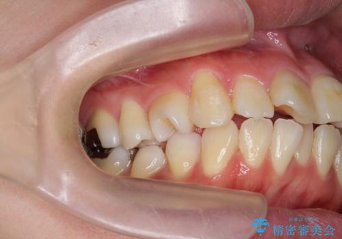 捻れた奥歯 突き出た前歯を治したいの治療前