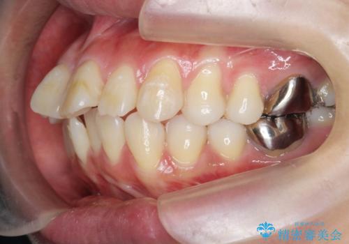 捻れた奥歯 突き出た前歯を治したいの治療前