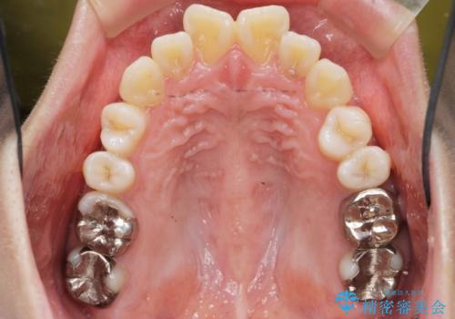 捻れた奥歯 突き出た前歯を治したいの治療前