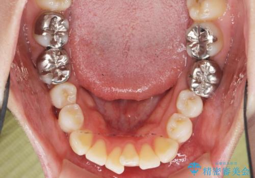 捻れた奥歯 突き出た前歯を治したいの治療前