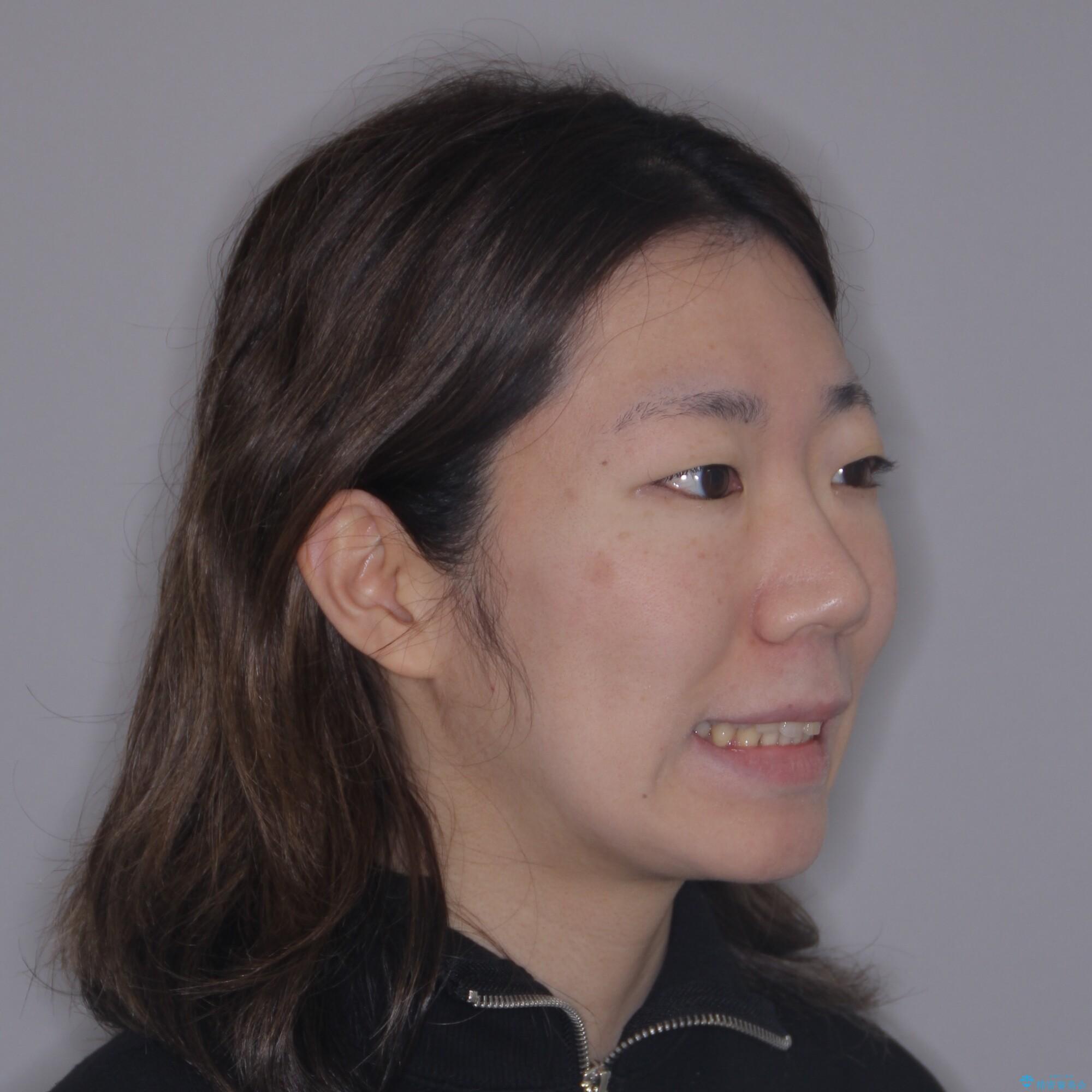 【モニター】飛び出した上顎前歯を抜歯矯正で引っ込める ワイヤー装置の抜歯矯正治療の治療後(顔貌)