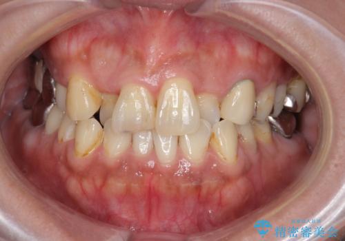 前歯が気になる。ブリッジによる治療。の治療前