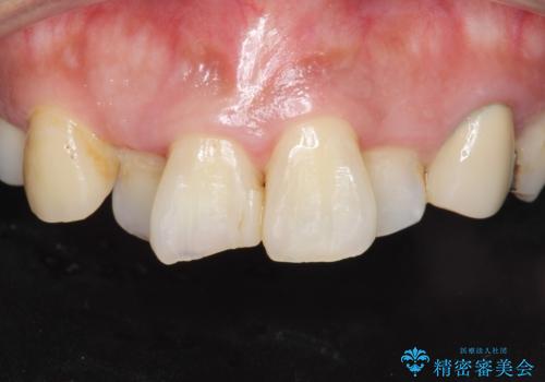 前歯が気になる。ブリッジによる治療。の治療前