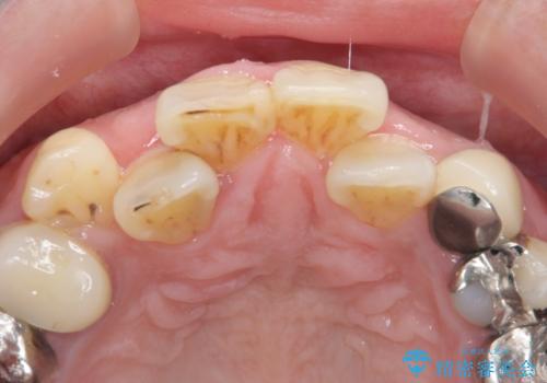 前歯が気になる。ブリッジによる治療。の治療前