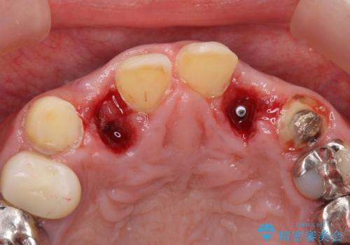 前歯が気になる。ブリッジによる治療。の治療中