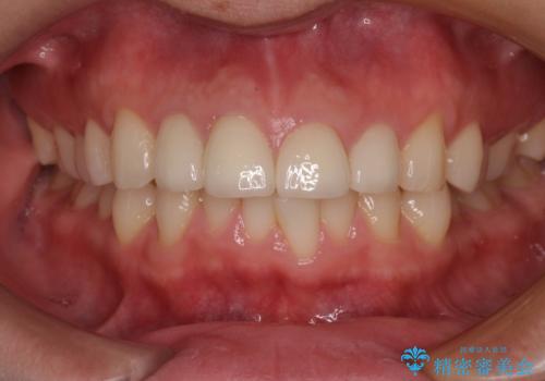 金属が見えて不自然な前歯をきれいにしたいの治療後
