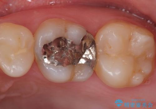 【VPT/歯髄温存療法・オールセラミッククラウン】虫歯が深く神経まで達していたが健康な神経は残す治療!の症例 治療前