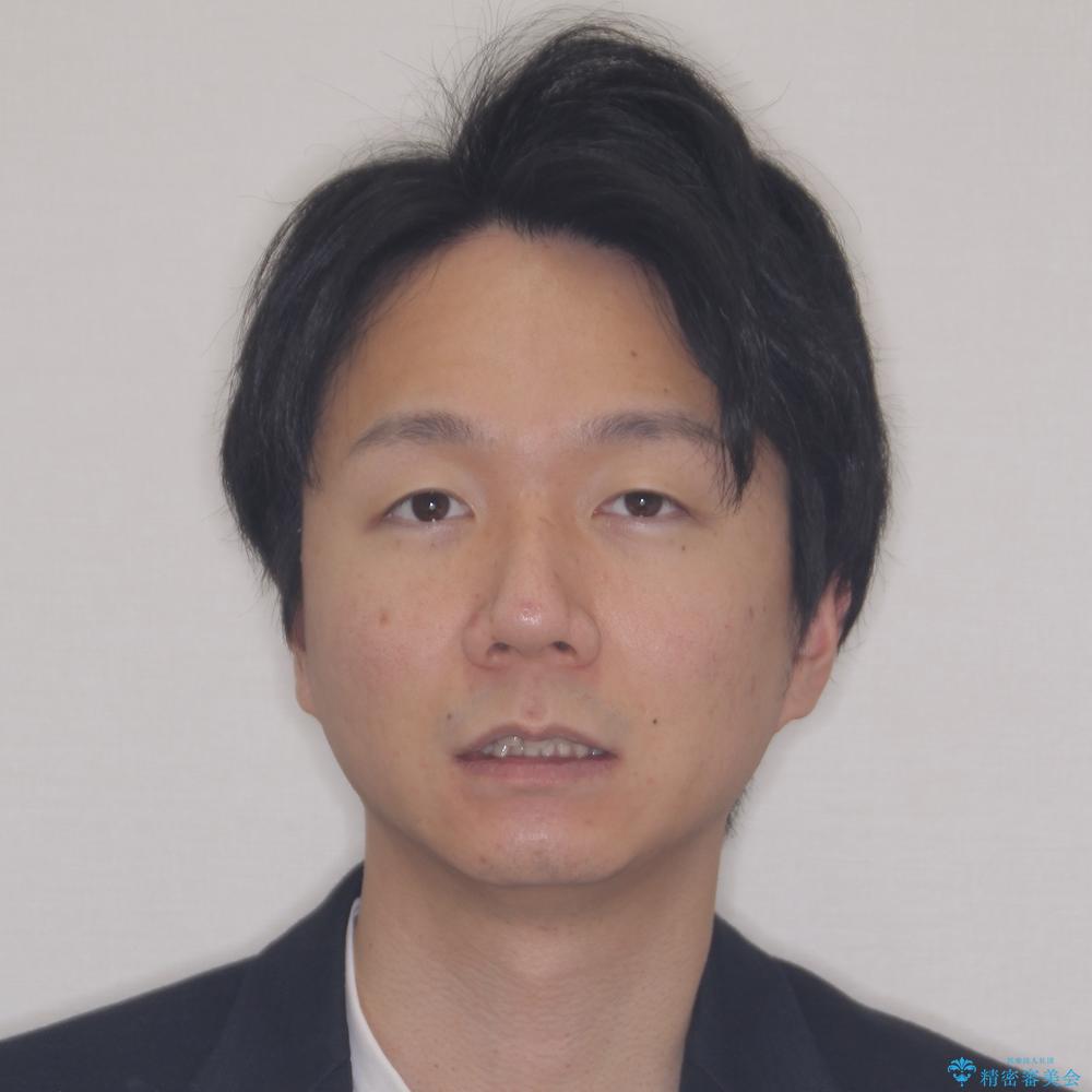 【モニター】八重歯と正中のずれた歯列 片顎抜歯のワイヤー矯正の治療前(顔貌)