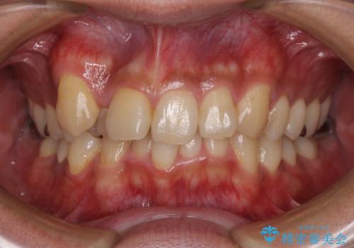 【モニター】八重歯と正中のずれた歯列　片顎抜歯のワイヤー矯正の症例 治療前