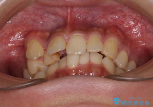 【モニター】八重歯と正中のずれた歯列　片顎抜歯のワイヤー矯正の治療前
