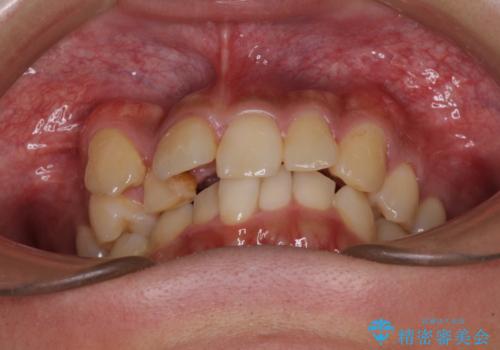 【モニター】八重歯と正中のずれた歯列 片顎抜歯のワイヤー矯正の治療前