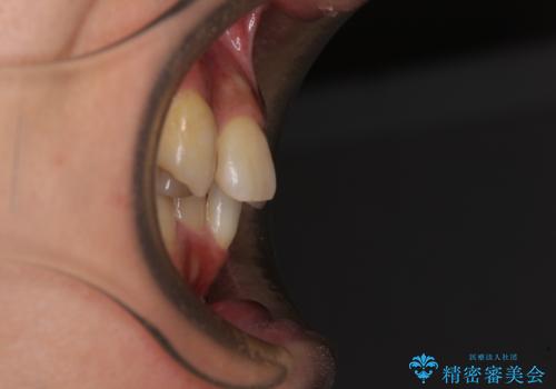 【モニター】八重歯と正中のずれた歯列 片顎抜歯のワイヤー矯正の治療前