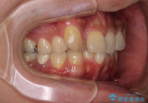 【モニター】八重歯と正中のずれた歯列　片顎抜歯のワイヤー矯正の治療前