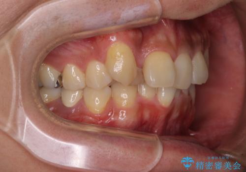 【モニター】八重歯と正中のずれた歯列 片顎抜歯のワイヤー矯正の治療前