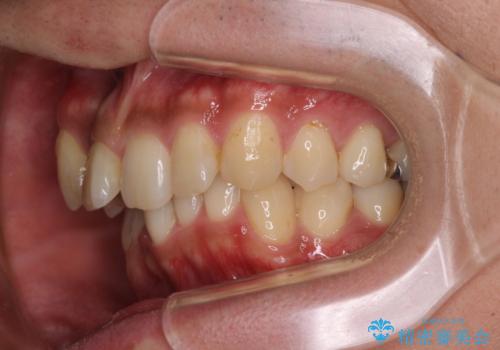 【モニター】八重歯と正中のずれた歯列 片顎抜歯のワイヤー矯正の治療前