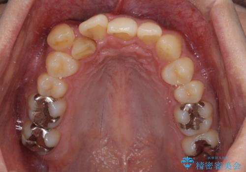 【モニター】八重歯と正中のずれた歯列 片顎抜歯のワイヤー矯正の治療前