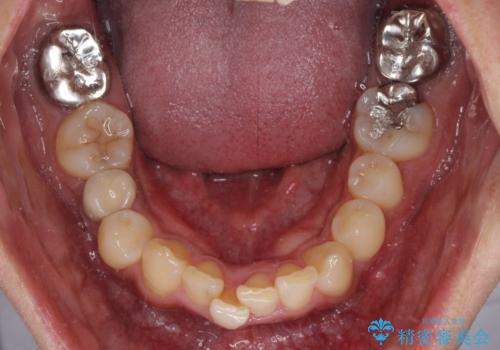 【モニター】八重歯と正中のずれた歯列 片顎抜歯のワイヤー矯正の治療前