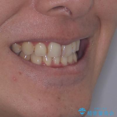 顎が左右にずれた咬み合わせ ハーフリンガルの抜歯矯正の治療後(顔貌)