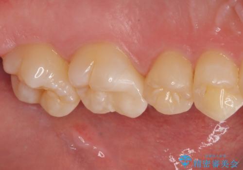 歯に穴が開いた セラミックインレー修復の治療後