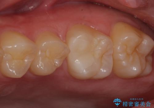 歯に穴が開いた セラミックインレー修復の治療後