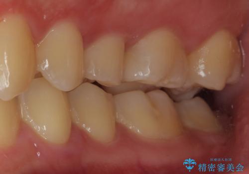 歯に穴が開いた　セラミックインレー修復の治療後