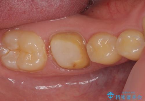 銀歯を白くしたい オールセラミッククラウンの治療中