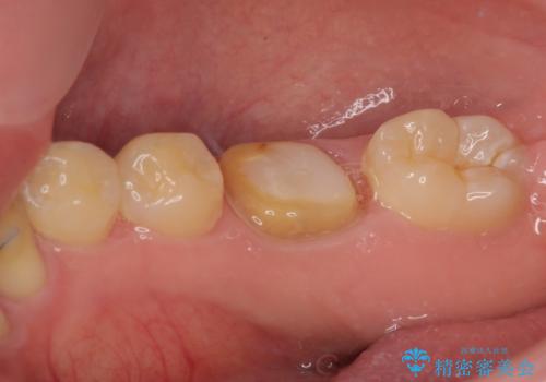 銀歯を白くしたい オールセラミッククラウンの治療中