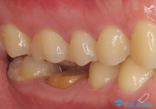 銀歯を白くしたい オールセラミッククラウンの治療中