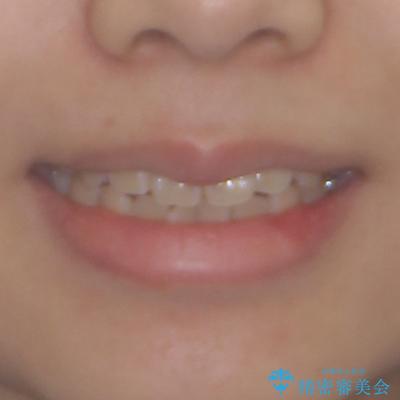 舌の突出癖による開咬と前歯の突出 インビザライン矯正治療の治療前(顔貌)