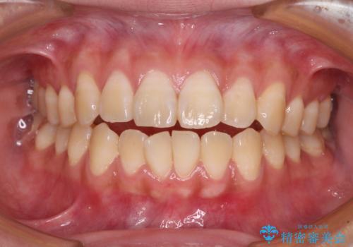 舌の突出癖による開咬と前歯の突出　インビザライン矯正治療の症例 治療前