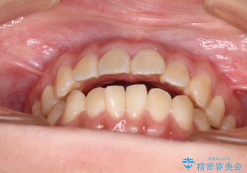 舌の突出癖による開咬と前歯の突出 インビザライン矯正治療の治療前