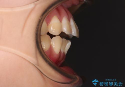 舌の突出癖による開咬と前歯の突出 インビザライン矯正治療の治療前