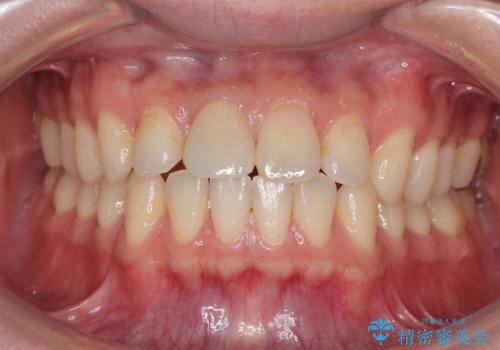 前歯のセラミックをやり替えたいの症例 治療後
