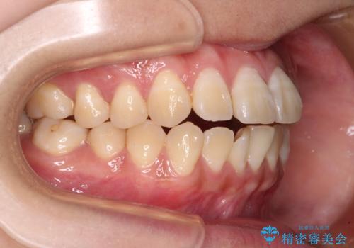 舌の突出癖による開咬と前歯の突出 インビザライン矯正治療の治療前
