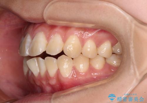 舌の突出癖による開咬と前歯の突出 インビザライン矯正治療の治療前