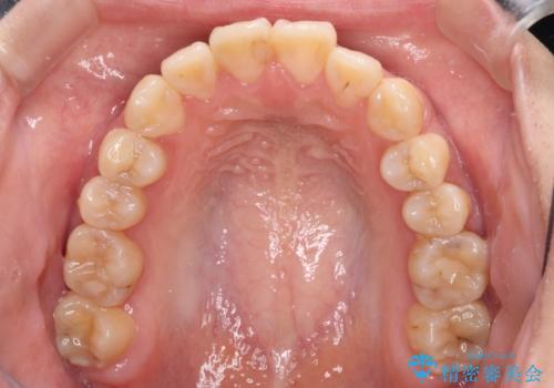 舌の突出癖による開咬と前歯の突出 インビザライン矯正治療の治療前