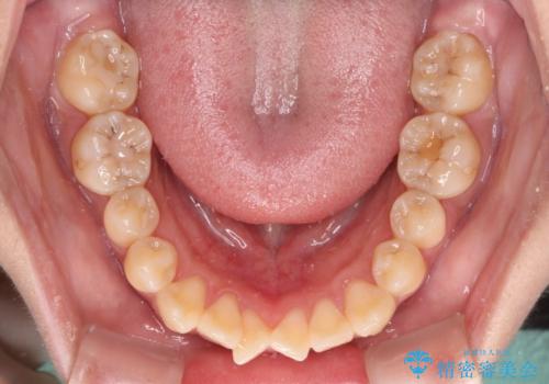舌の突出癖による開咬と前歯の突出 インビザライン矯正治療の治療前