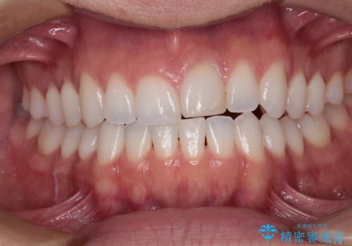 ぶつけて変色した前歯 オールセラミッククラウン治療の治療前