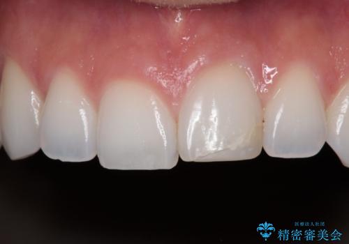 ぶつけて変色した前歯 オールセラミッククラウン治療の症例 治療前