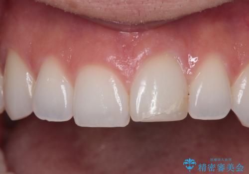 ぶつけて変色した前歯 オールセラミッククラウン治療の治療前
