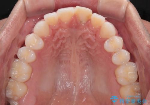 ぶつけて変色した前歯 オールセラミッククラウン治療の治療前