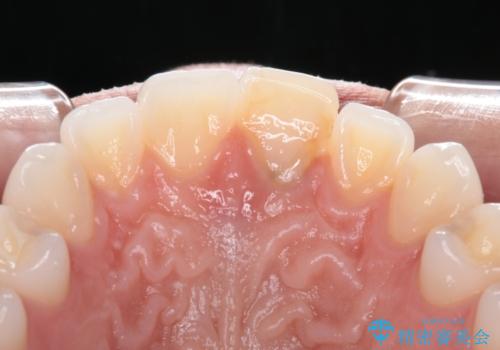 ぶつけて変色した前歯 オールセラミッククラウン治療の治療前