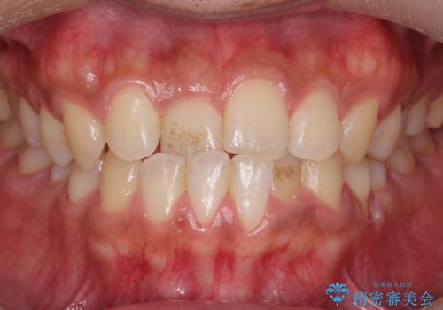 骨格性の受け口の矯正　部分ワイヤーで上の前歯を前に、　マウスピースで下の前歯を後ろに。