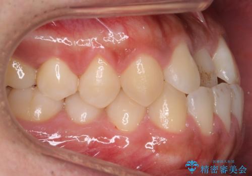 骨格性の受け口の矯正 部分ワイヤーで上の前歯を前に、 マウスピースで下の前歯を後ろに。の治療前