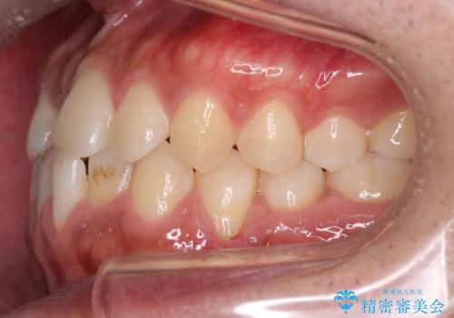 骨格性の受け口の矯正 部分ワイヤーで上の前歯を前に、 マウスピースで下の前歯を後ろに。の治療前