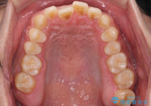 骨格性の受け口の矯正 部分ワイヤーで上の前歯を前に、 マウスピースで下の前歯を後ろに。の治療前