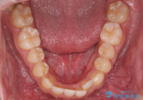 骨格性の受け口の矯正 部分ワイヤーで上の前歯を前に、 マウスピースで下の前歯を後ろに。の治療前