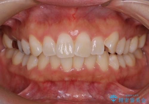 【審美装置】上下の前歯をきれいにしたい の症例 治療前